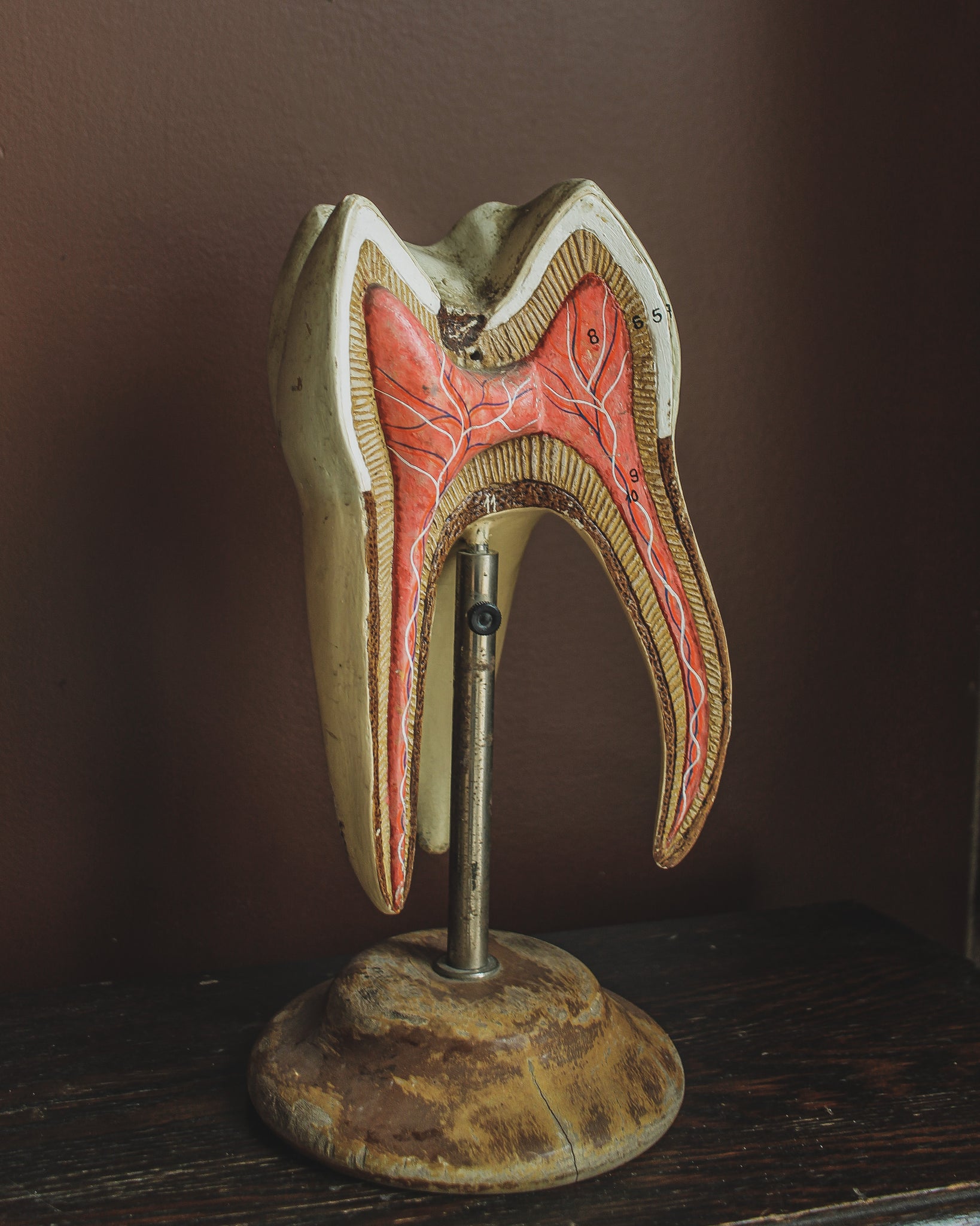 Cavitied Tooth Model Display