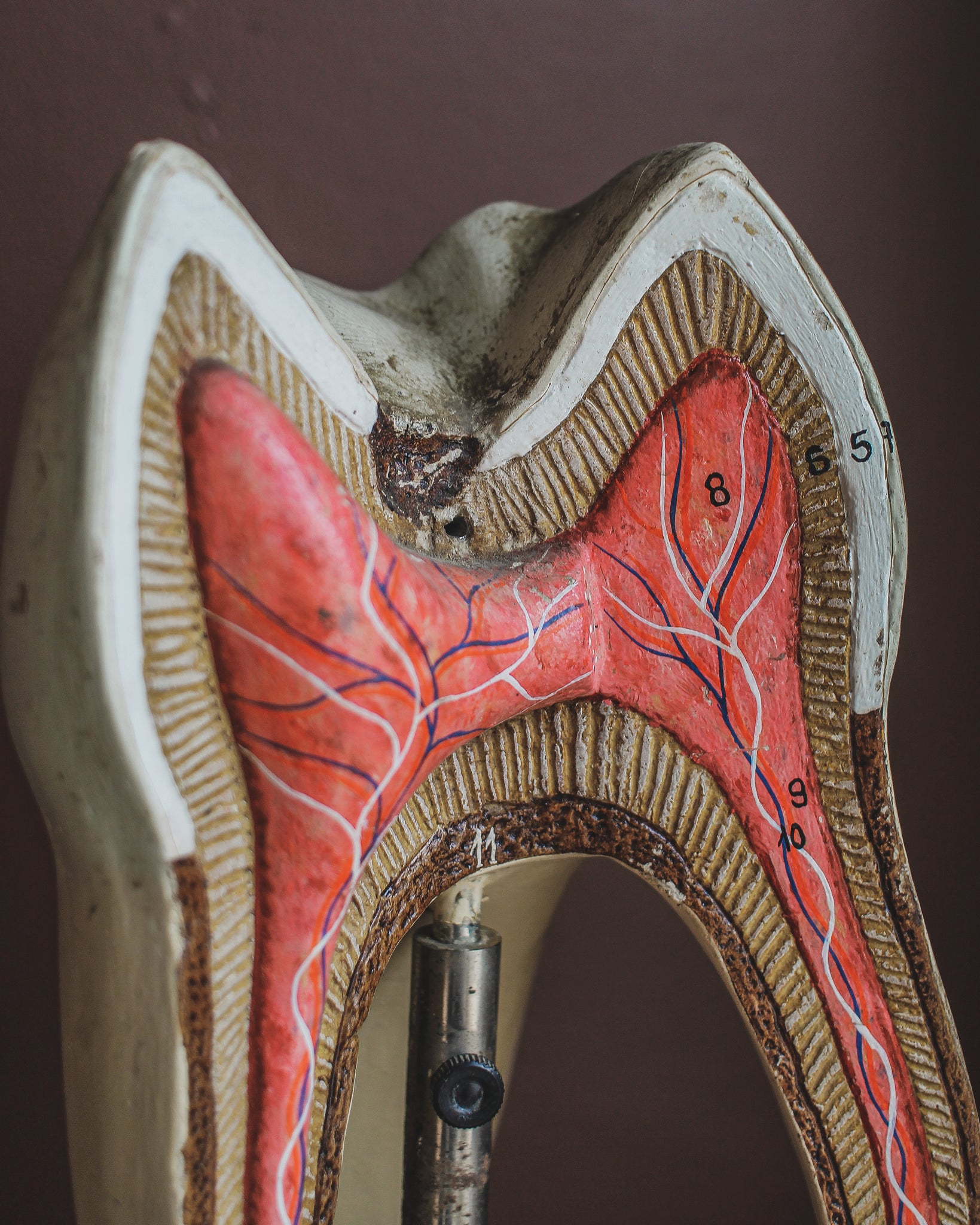 Cavitied Tooth Model Display